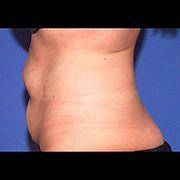 Bauchdeckenstraffung, 39 Vorher Nachher