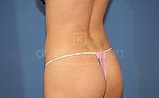 Fettabsaugung, 26 Vorher Nachher