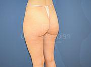 Fettabsaugung, 29 Vorher Nachher