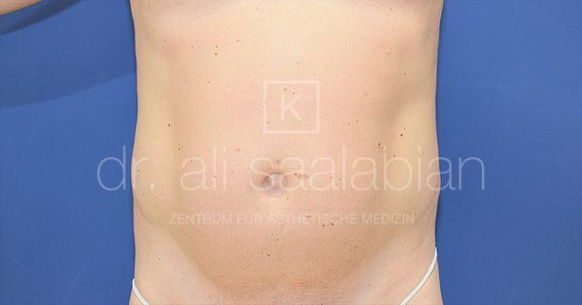 Fettabsaugung, 53 Vorher Nachher