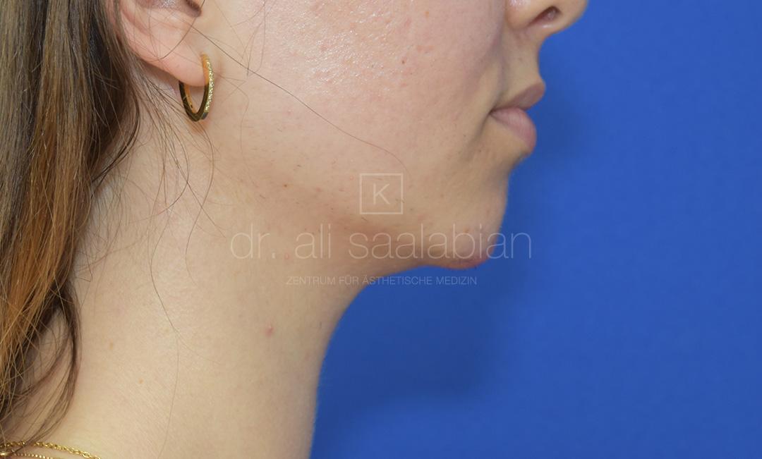 Fettabsaugung, 23 Vorher Nachher