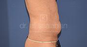 Fettabsaugung, 45 Vorher Nachher