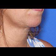 Fettabsaugung, 46 Vorher Nachher