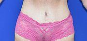 Bauchdeckenstraffung, 46 Vorher Nachher