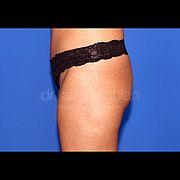 Fettabsaugung, 43 Vorher Nachher