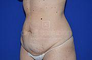 Bauchdeckenstraffung, 33 Vorher Nachher