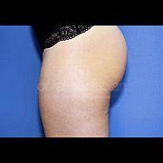 Fettabsaugung, 31 Vorher Nachher