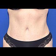 Bauchdeckenstraffung, 47 Vorher Nachher