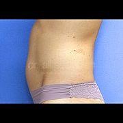 Fettabsaugung, 31 Vorher Nachher