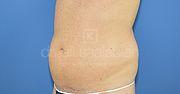 Fettabsaugung, 37 Vorher Nachher