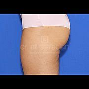 Fettabsaugung, 31 Vorher Nachher