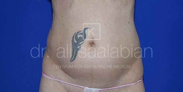 Fettabsaugung, 54 Vorher Nachher