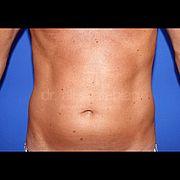 Fettabsaugung, 51 Vorher Nachher