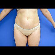 Fettabsaugung, 24 Vorher Nachher