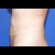 Fettabsaugung, 62 Vorher Nachher