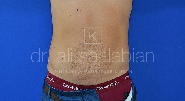 Fettabsaugung, 40 Vorher Nachher