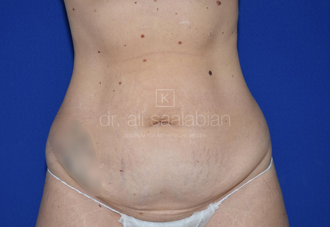 Bauchdeckenstraffung, 33 Vorher Nachher