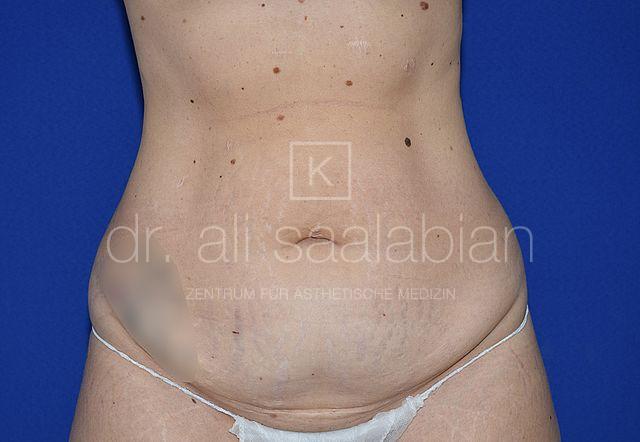 Bauchdeckenstraffung, 33 Vorher Nachher