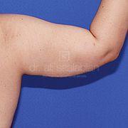 Fettabsaugung, 34 Vorher Nachher