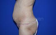 Fettabsaugung, 54 Vorher Nachher