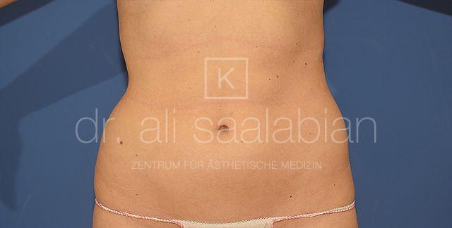 Fettabsaugung, 29 Vorher Nachher