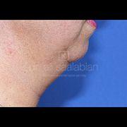 Fettabsaugung, 46 Vorher Nachher