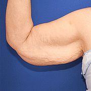 Oberarmstraffung, 61 Vorher Nachher