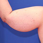 Fettabsaugung, 34 Vorher Nachher