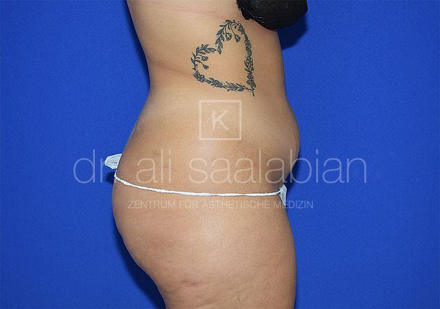 Fettabsaugung, 21 Vorher Nachher
