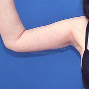 Oberarmstraffung, 50 Vorher Nachher