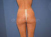 Fettabsaugung, 29 Vorher Nachher
