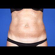 Fettabsaugung, 51 Vorher Nachher