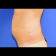 Fettabsaugung, 29 Vorher Nachher