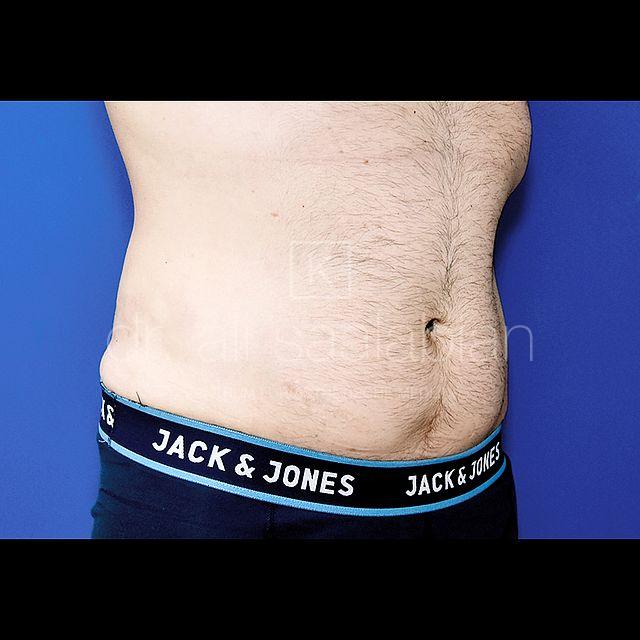 Fettabsaugung, 32 Vorher Nachher