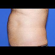 Fettabsaugung, 48 Vorher Nachher