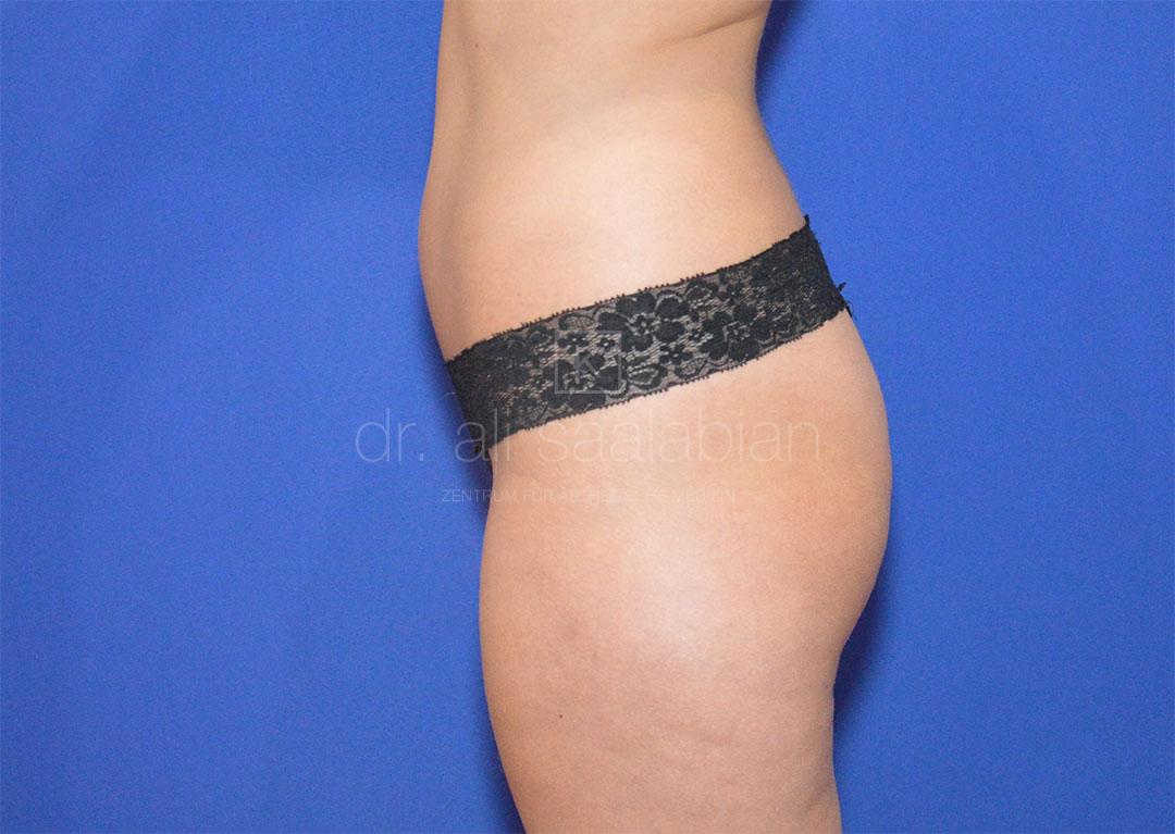 Body Contouring, 26 Vorher Nachher