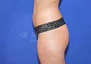 Body Contouring, 26 Vorher Nachher