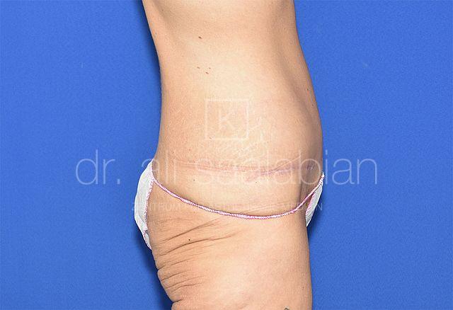 Bauchdeckenstraffung, 38 Vorher Nachher