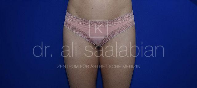 Fettabsaugung, 33 Vorher Nachher