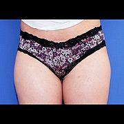 Fettabsaugung, 25 Vorher Nachher