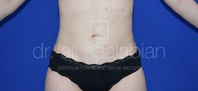 Fettabsaugung, 30 Vorher Nachher