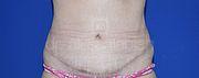 Bauchdeckenstraffung, 32 Vorher Nachher