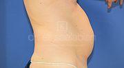 Fettabsaugung, 53 Vorher Nachher