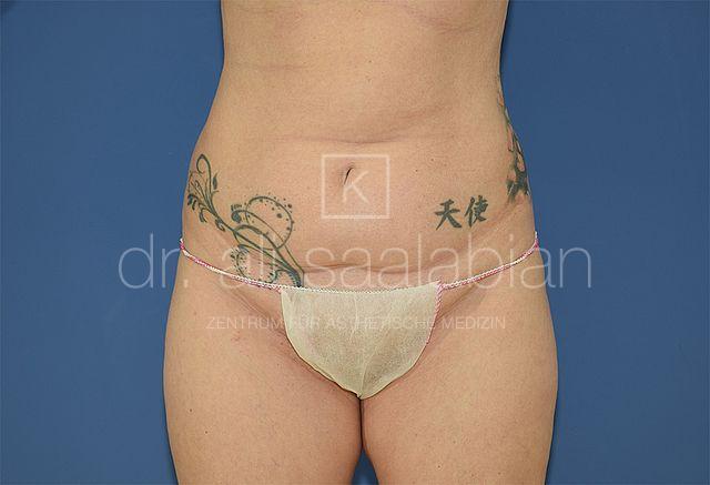 Fettabsaugung, 50 Vorher Nachher