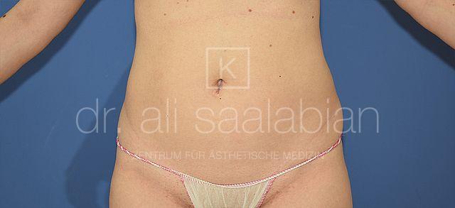 Fettabsaugung, 30 Vorher Nachher