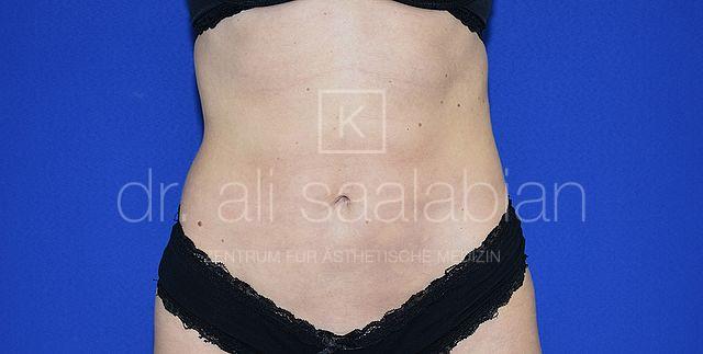 Fettabsaugung, 29 Vorher Nachher