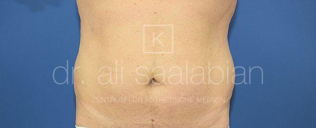 Fettabsaugung, 58 Vorher Nachher