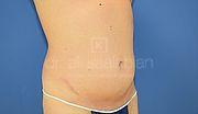 Fettabsaugung, 40 Vorher Nachher