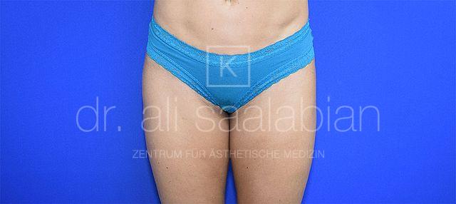 Fettabsaugung, 33 Vorher Nachher