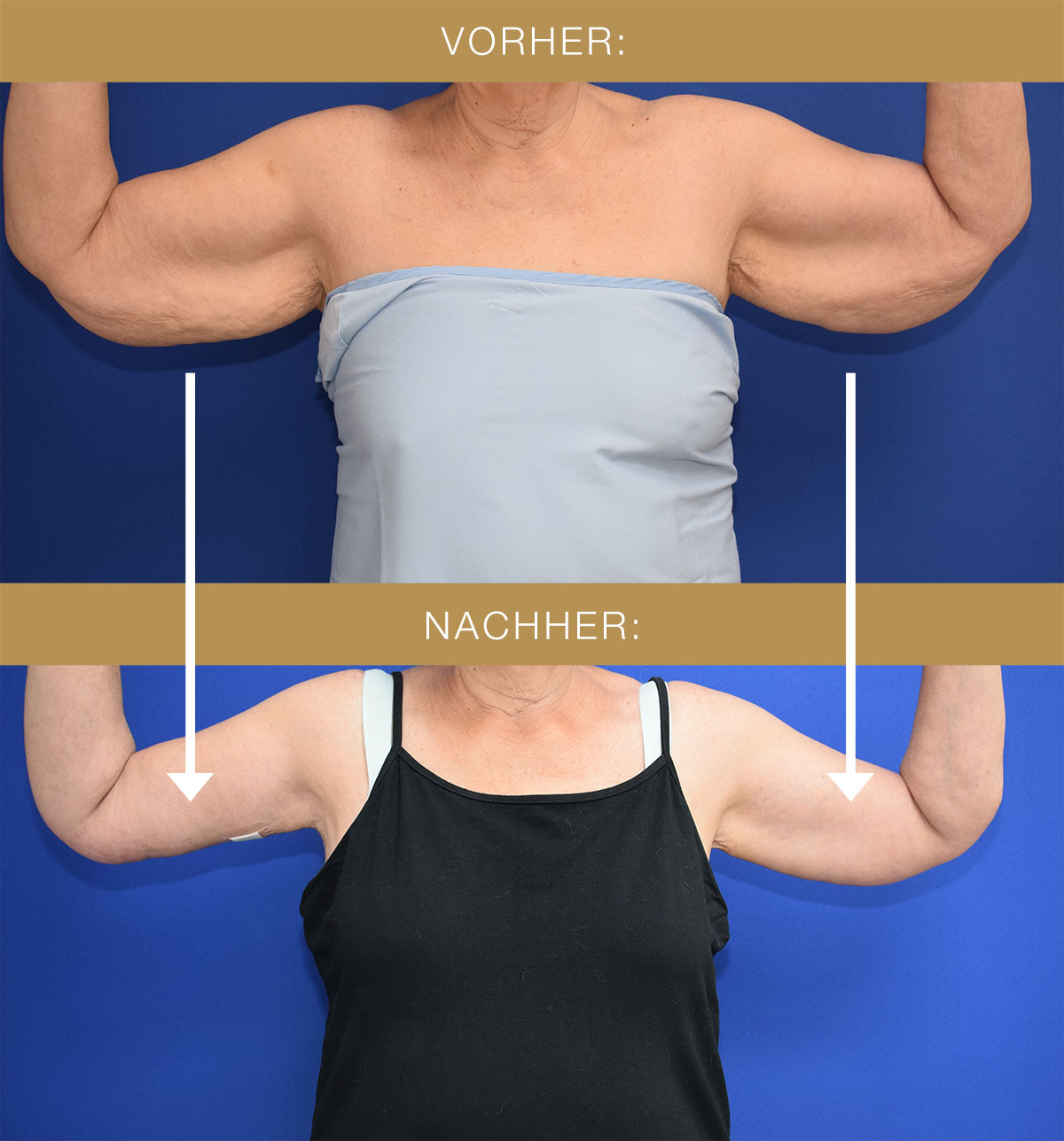 Korperstraffung Bauchdeckenstraffung Oberarmstraffung Perfekter Korper Fettabsaugung Korperstraffung Wien